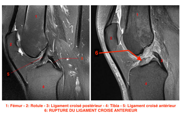 Rupture Du Ligament Crois Ant Rieur Docteur Bruno L Vy