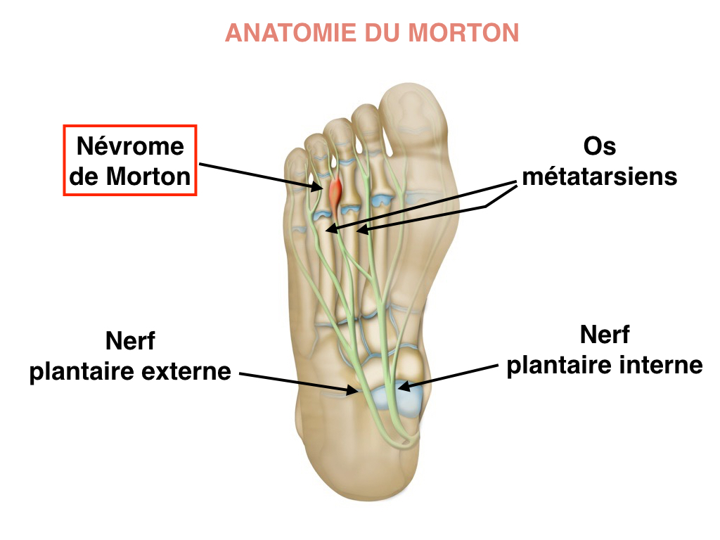 Anatomie du névrome de Moton