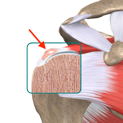 Calcific Tendinitis of the Shoulder