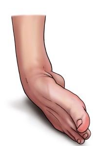 sprained-ankle-30252