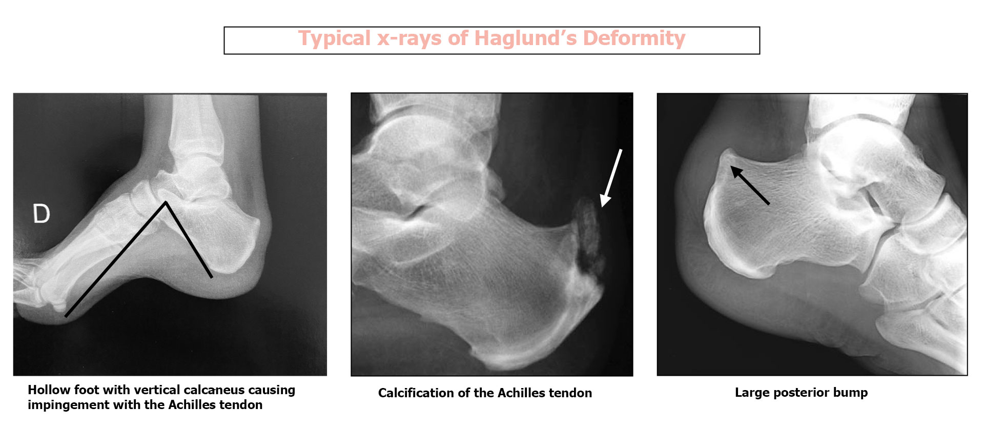 Haglund's Deformity - Docteur Bruno Lévy