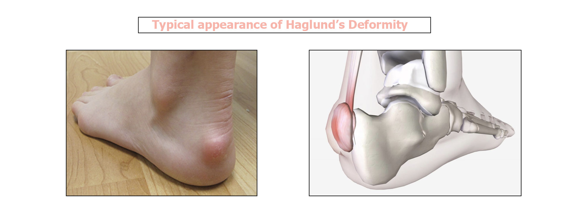 Schedule a Hammer Toe Surgery in Chicago, IL - Keyes for Toes