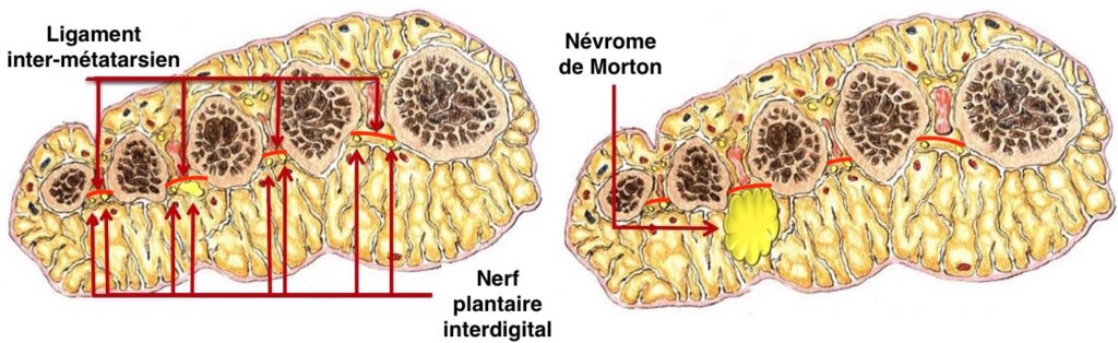 Nerf plantaire