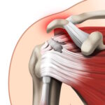 Rupture de la coiffe des rotateurs