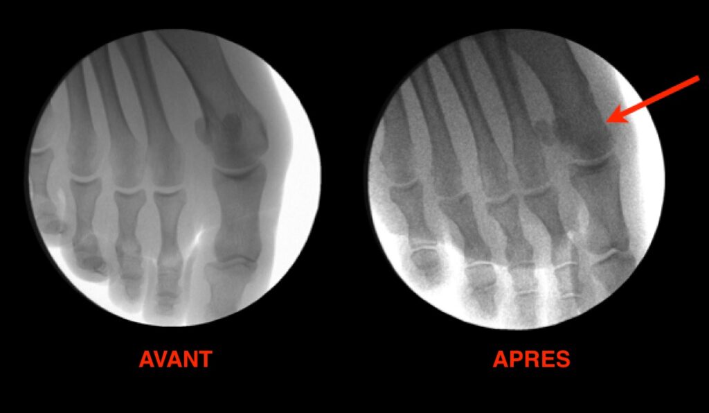 Radiographies Ostéotomies