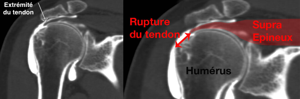 Rupture du tendon supra-épineux