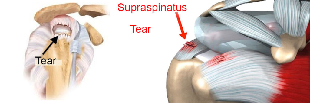  rotator cuff tear