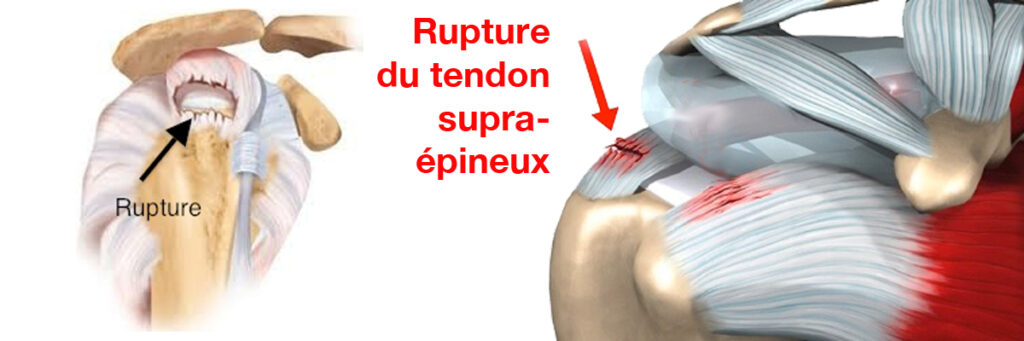 Rupture du tendon supra-epineux