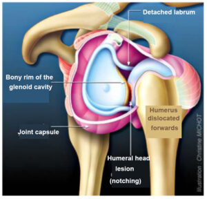 shoulder dislocation