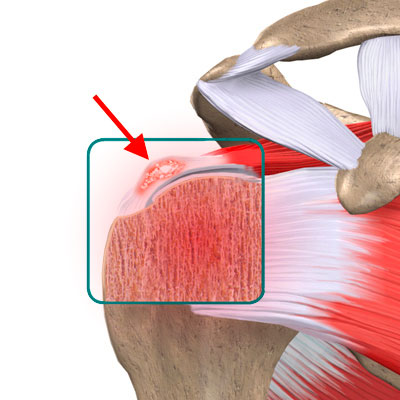 Shoulder Calcifications