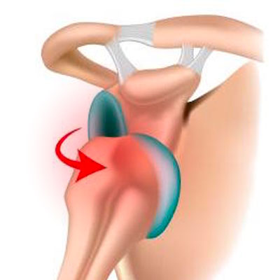 Recurrent Shoulder Dislocations