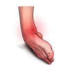 Ankle Sprains and Ligament Reconstruction