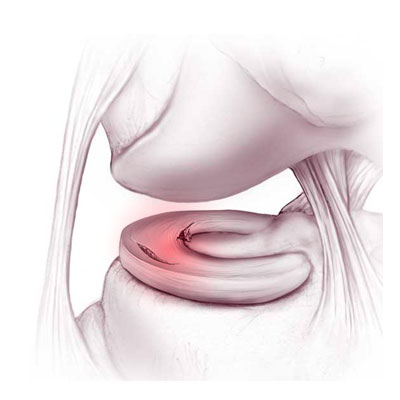 Meniscal pathologies