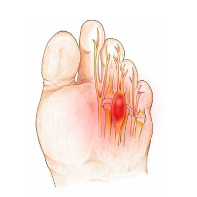 Morton's syndrome