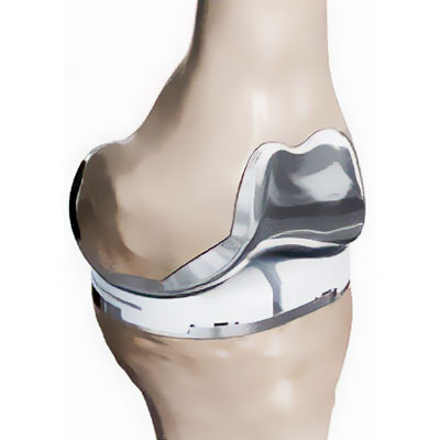 Total Knee Replacement