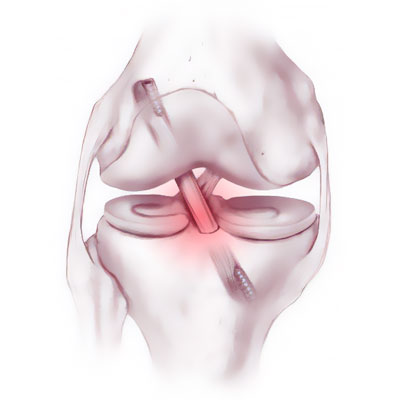 Anterior Cruciate Ligament Rupture