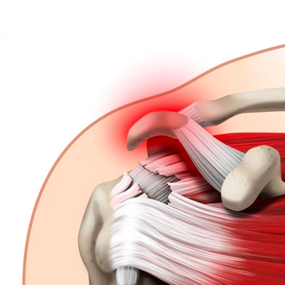 Rotator cuff tear