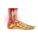 Achilles Tendon Rupture