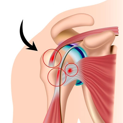 Rotator Cuff Tendinopathies