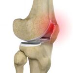 Patellar pathologies