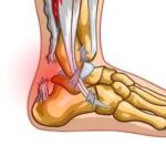 Achilles Tendon Rupture